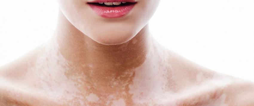 5 وصفات طبيعية لعلاج مرض البهاق