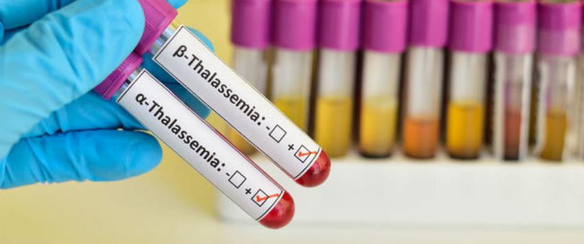 علاج وراثي جديد يحمل الأمل لملايين المصابين بالثلاسيميا