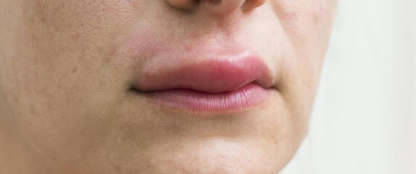 كيف يتم علاج لدغة البعوض على الشفاه؟