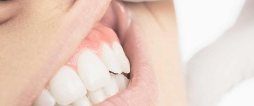 ما هي أسباب التجاويف التي تحدث بالقرب من خط اللثة وكيف يتم علاجها؟