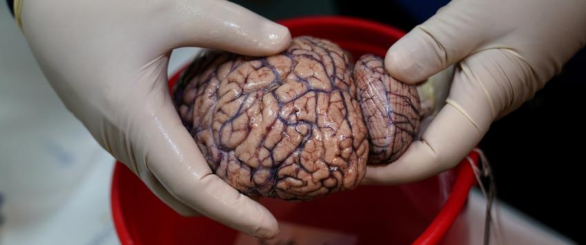 غرسة في الدماغ