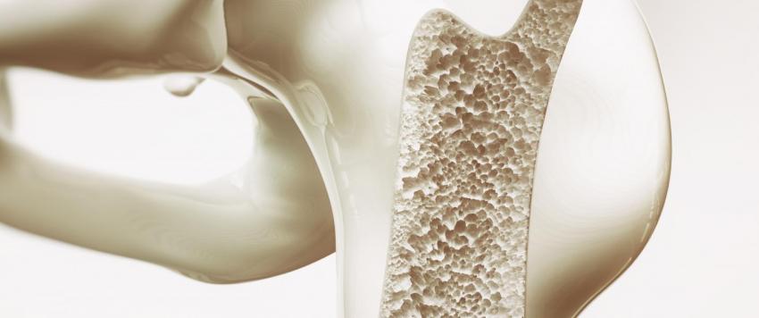 هشاشة العظام: تعريفها، أسبابها، علاجها