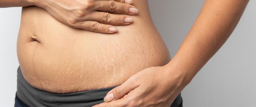 تعرفي على أفضل الطرق لإزالة علامات التمدد في الجلد بعد الولادة