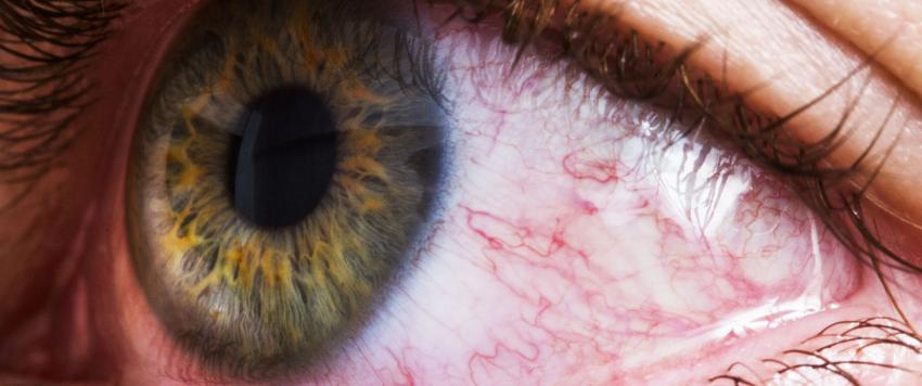  نصائح بسيطة لتخفيف التهابات العين الوردية.. تعرف عليها