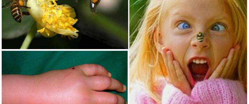 طفل يتعرض للدغة نحل