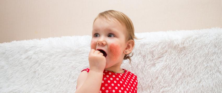 كيف تعرفين ما إذا كانت بشرة طفلك حساسة