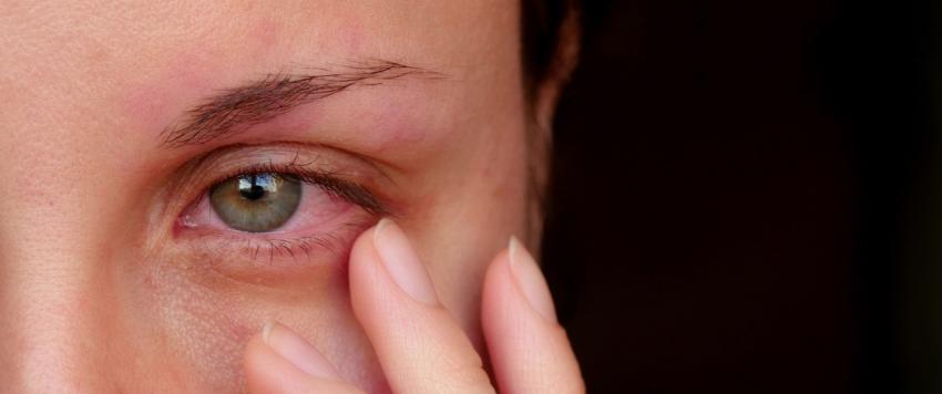 6 طرق بسيطة للتخلص من إحمرار العين بالمنزل