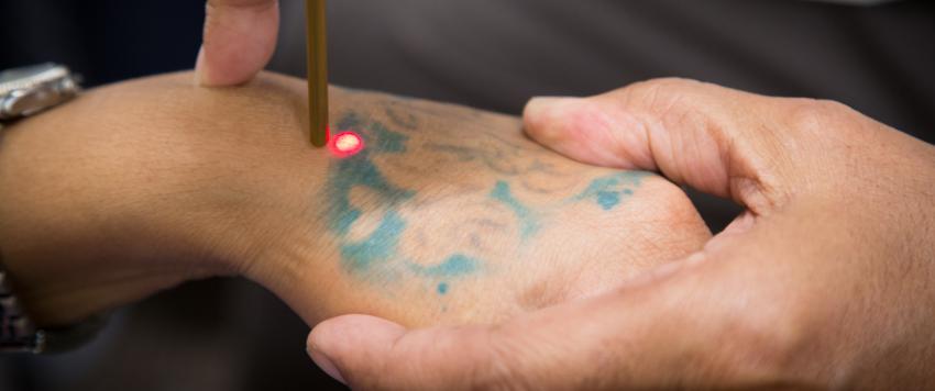 مشاهير أزالوا وشومهم ومنهم من أخفاها بأخرى