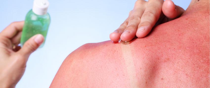 علاجات منزلية لمعالجة أضرار أشعة الشمس على البشرة والشعر