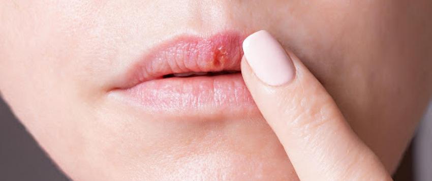 إلتهاب الشفاه