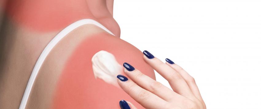 تعرفي على فوائد زيت جوز الهند لعلاج حروق الشمس