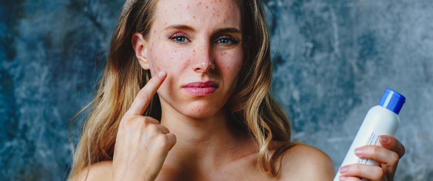 7 أخطاء للعناية بالبشرة يمكن أن تسبب لك حب الشباب