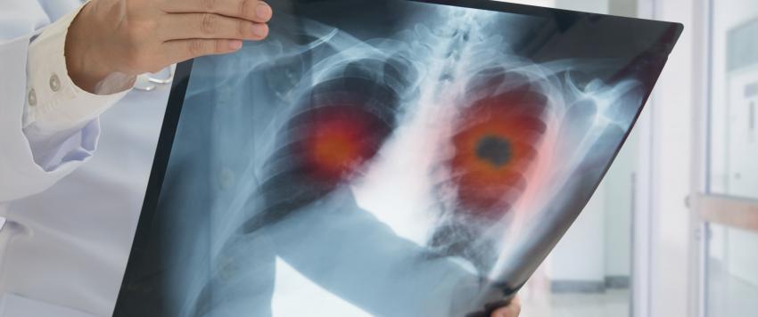 مريض عمره 35 عاماً ينجو في معركة مع نوعين منفصلين من السرطان ويوجه رسالة عاجلة للمجتمع