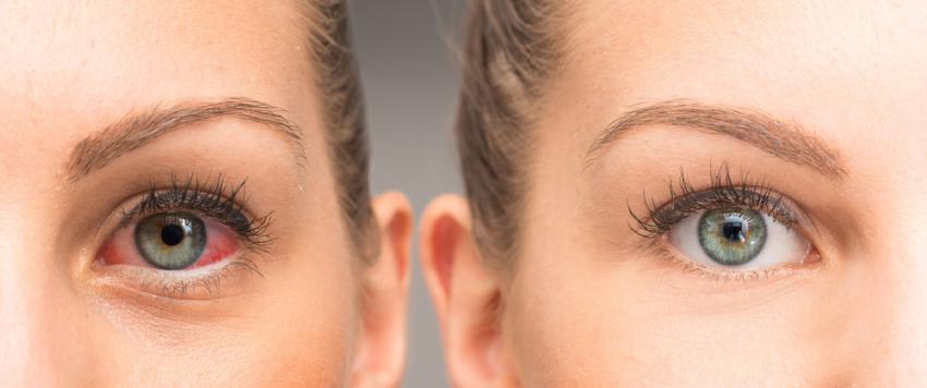 التهاب القزحية