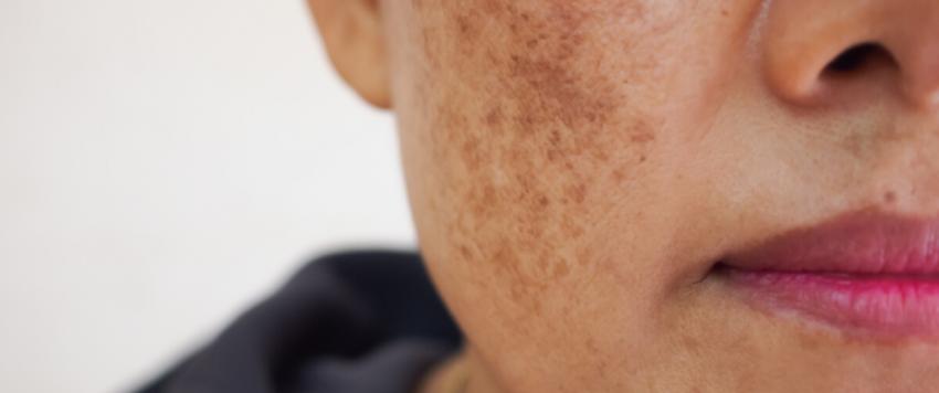 هل هناك رابط بين حبوب منع الحمل والكلف؟ 