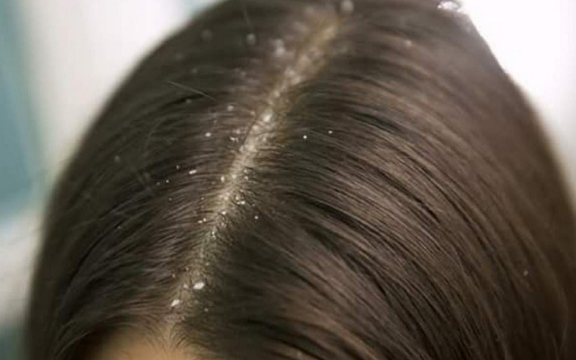 علاج فروة الرأس من القشرة والقمل: نتعرض في بعض الأحيان إلى الإصابة بالقشرة أو القمل الذي يسبب إزعاجاً كبيراً، البابونج من الأعشاب الطبية الأكثر شعبية التي يمكنكِ استخدامها في علاج هذه المشاكل وذلك بوضع منقوع البابونج كـ "ماسك" للشعر.